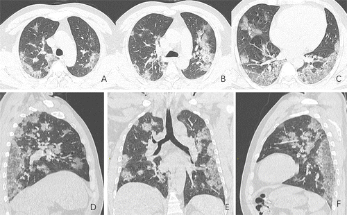 Pulmones de paciente de Wuhan que falleció a causa del coronavirus (RSNA)