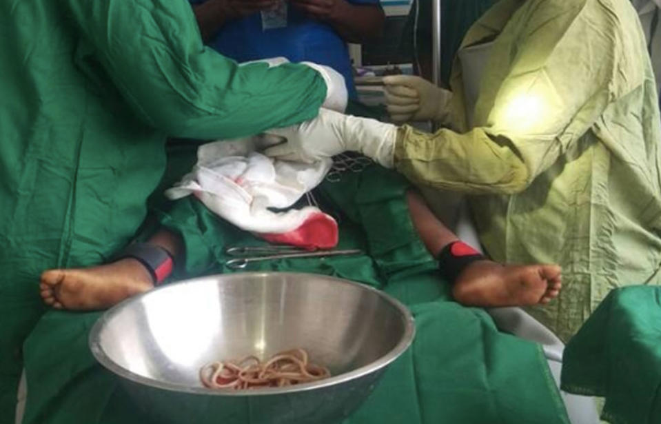 Surgeons remove "bundles" of worms from the boy's intestines at the hospital in Cameroon.