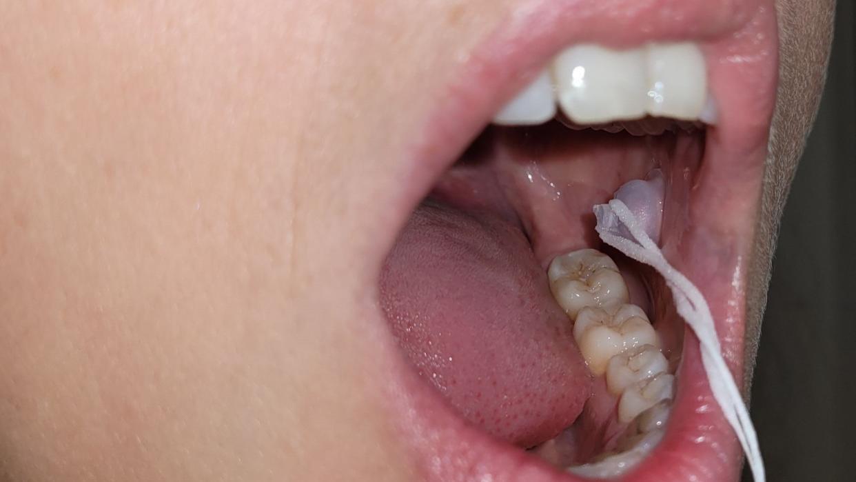 An open mouth showing a drug delivery patch adhered to a cheek.