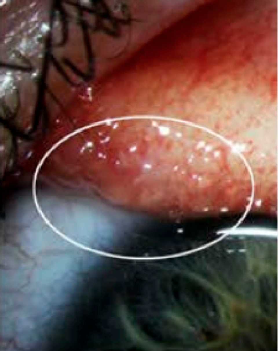 <em>Unusual – doctors hadn’t seen anything like it before (Picture: CDC)</em>