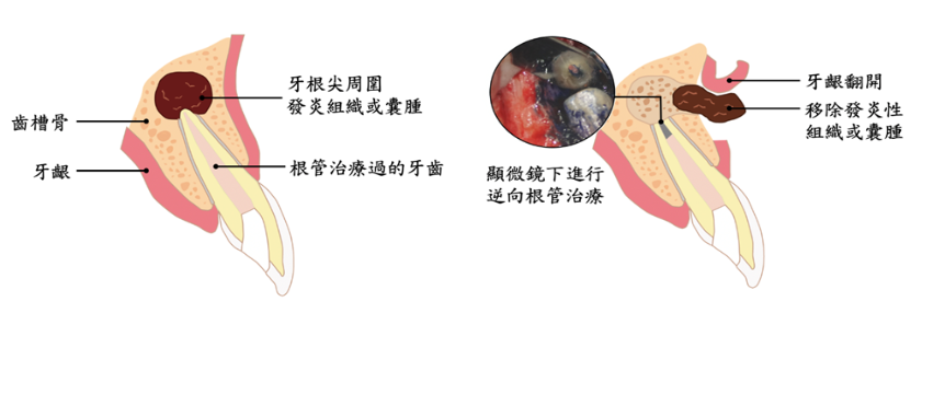 台北榮總指出，微創根尖周圍手術是透過顯微鏡進行逆向根管治療，可成功保留患者牙齒。（台北榮總提供）