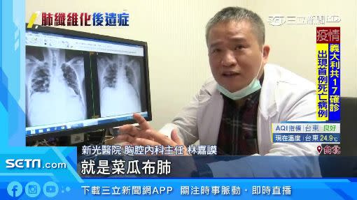 林嘉謨醫師說肺纖維化是胸腔科俗稱的「菜瓜布肺」。