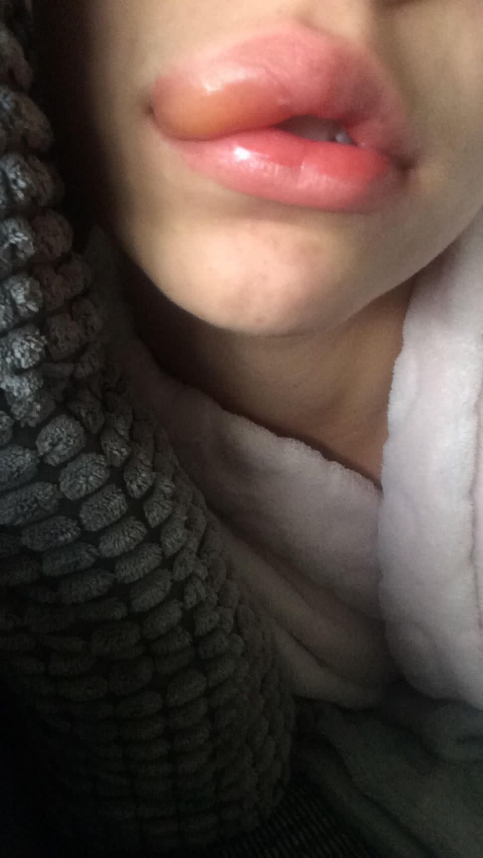 Larissa Reynolds was left with terrible swelling after using a counterfeit lip gloss. Source: Caters