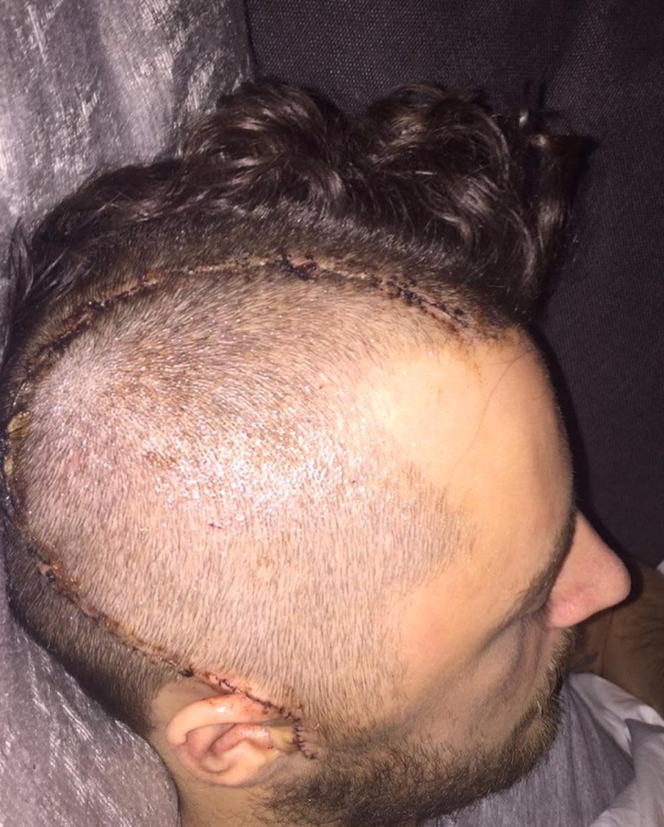 Ryan Mason revealed his scars on Instagram.