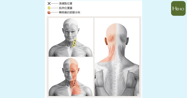 圖片來源：經《醫學瑜伽 解痛聖經：乾針名醫Dr.Victor精準對症》三采文化授權使用，未經許可不得任意轉載。