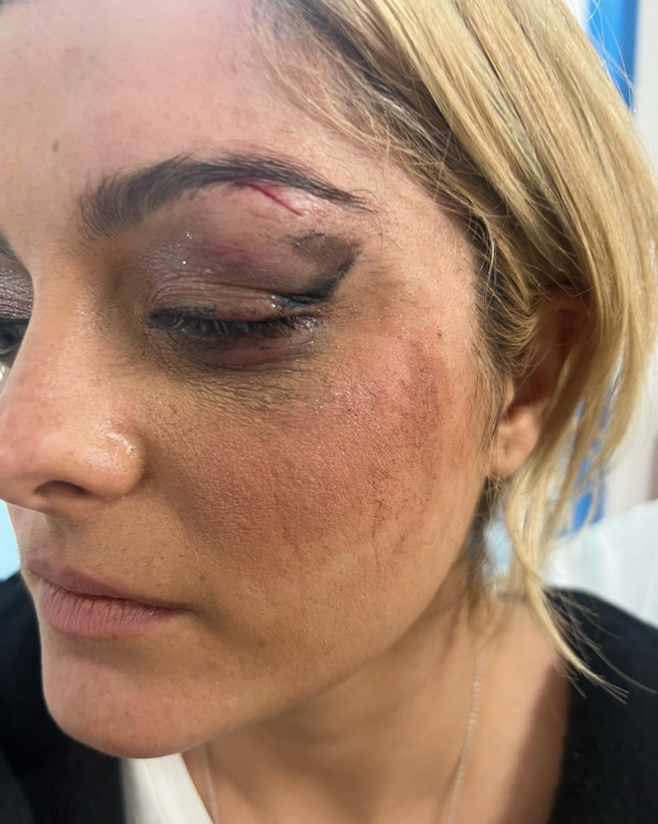 Bebe Rexha’s eye looked badly bruised following the incident (Instagram/Bebe Rexha)