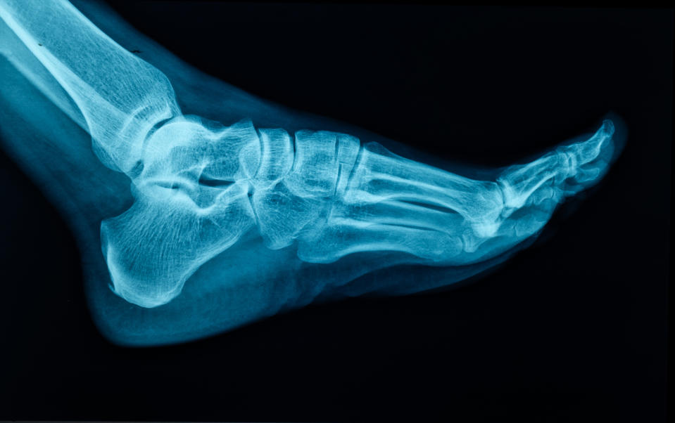 X-ray of someone's foot