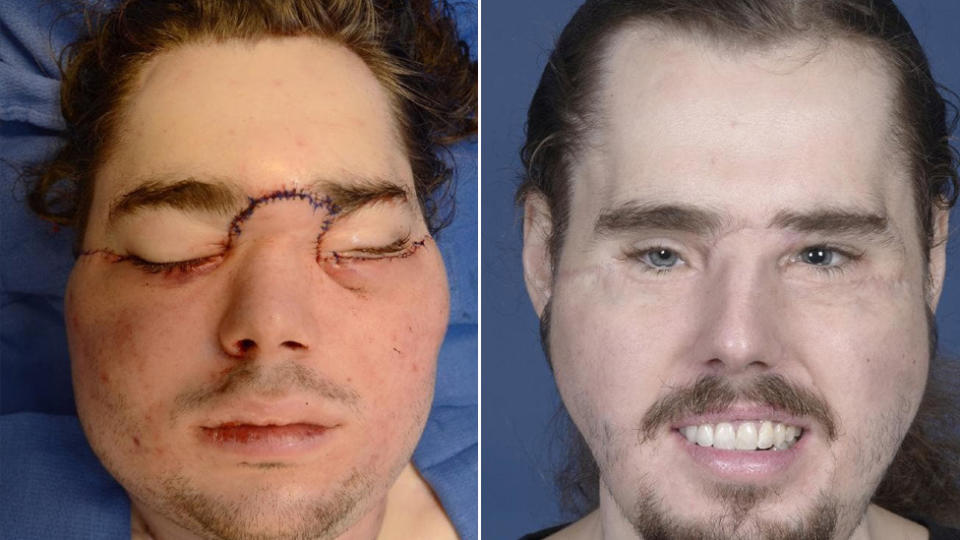 Cameron Underwood underwent a marathon 25-hour operation. (Photos: NYU Langone Health)