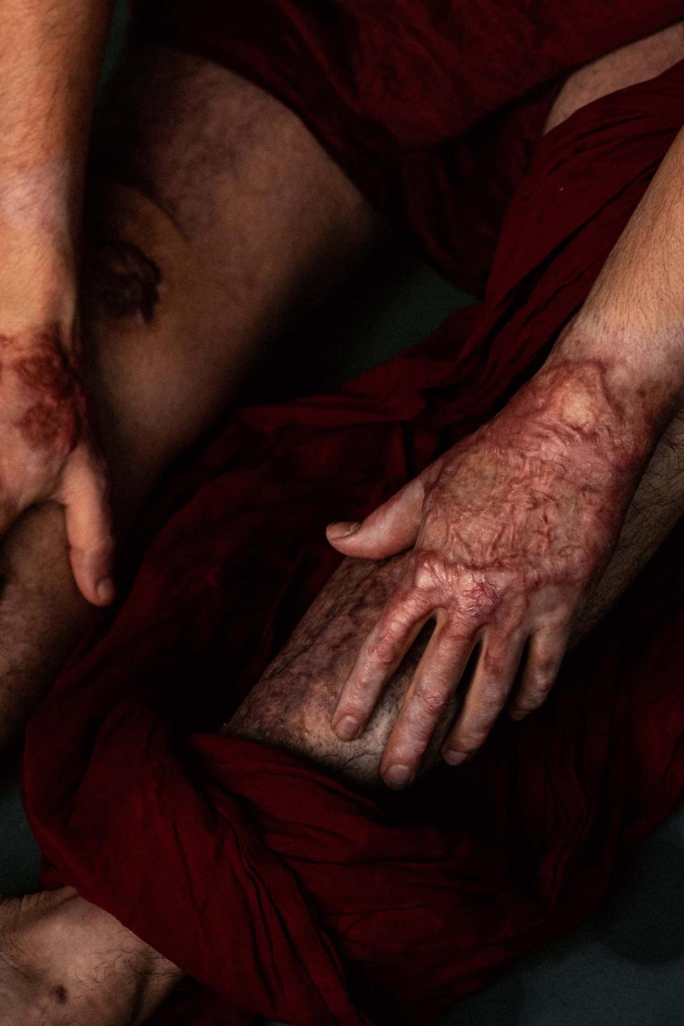 A photo by Marta Syrko of Ilya, Ukrainian soldier who was burned in combat. A closely-cropped overhead view of his hand, red with burn marks, as well as part of his thigh, other hand, and a swathe of red cloth.