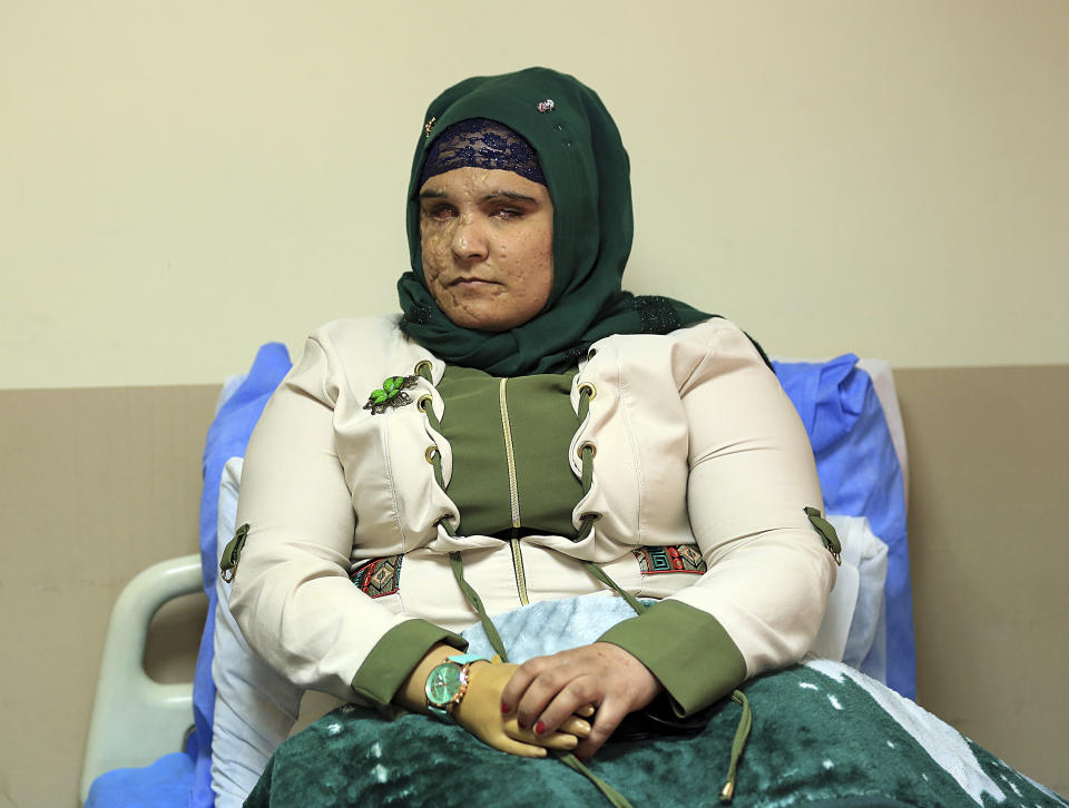 In this Monday, Nov. 5, 2018 photo, Saja Ahmed Saleem, who was injured in an explosion in 2007, talks to The Associated Press before her reconstructive surgery in Baghdad, Iraq. Those whom treatment not available at state-run hospitals and can’t afford treatment at private clinics rely on social media to make appeals that grab attention of some surgeons to help them regain a chance at life. (AP Photo/Hadi Mizban)