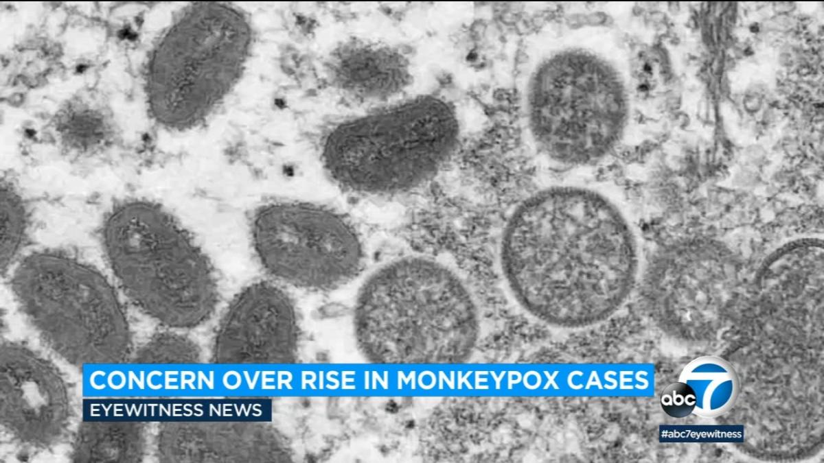 Los Angeles County warns of monkeypox vaccine shortage