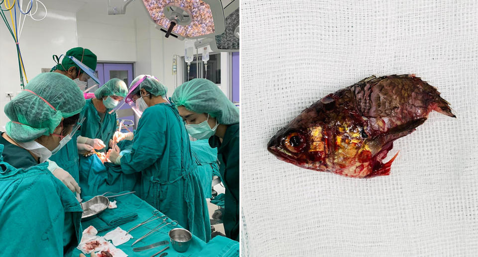 Doctors seen performing surgery on the man and the bloodied fish that was removed.