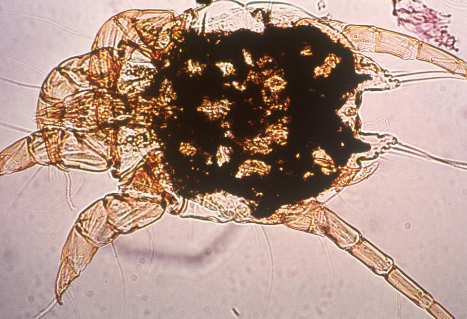 Imagen microscópica del ácaro Sarcoptes scabiei. (Photo By BSIP/UIG Via Getty Images)