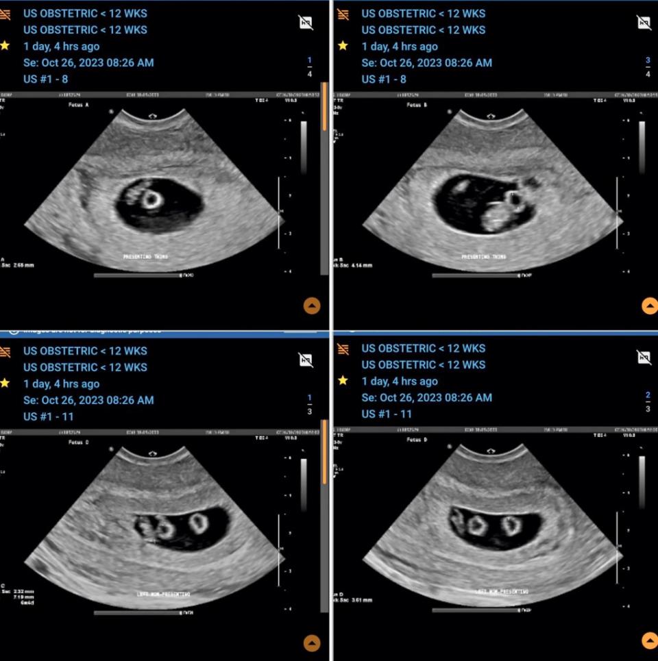 Doctors discovered that there were two babies in each of the sacs, meaning that Apps is pregnant with two sets of identical twins. Ebony Apps / CATERS NEWS