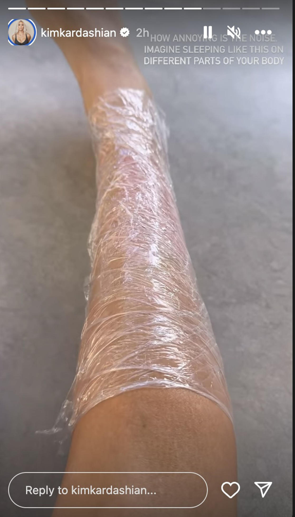 Kim Kardashian shares up close pics of her psoriasis and her hack for easing her symptoms (@kimkardashian via Instagram)