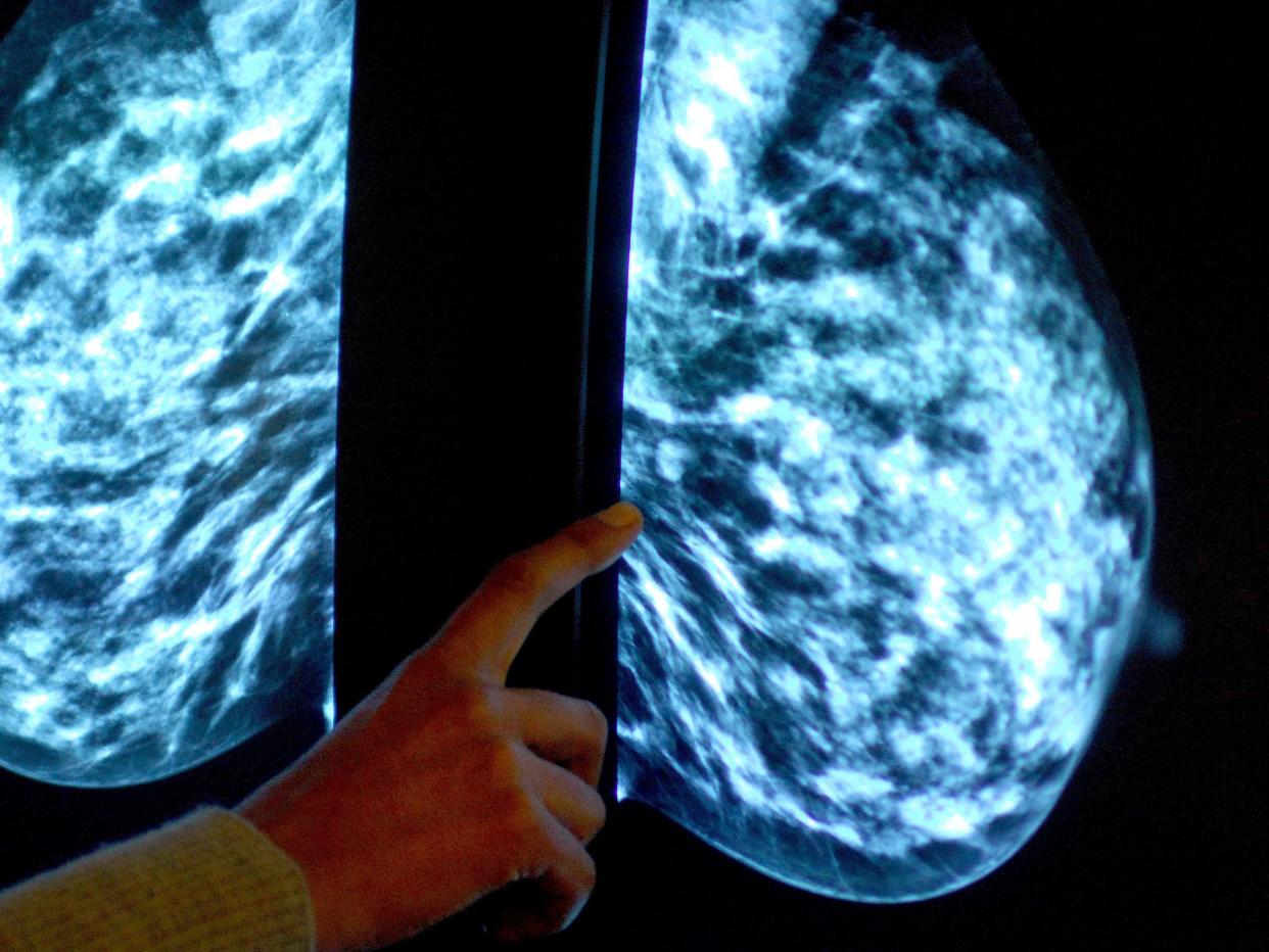 Seventy per cent of women with the most common type of breast cancer could avoid chemotherapy: PA
