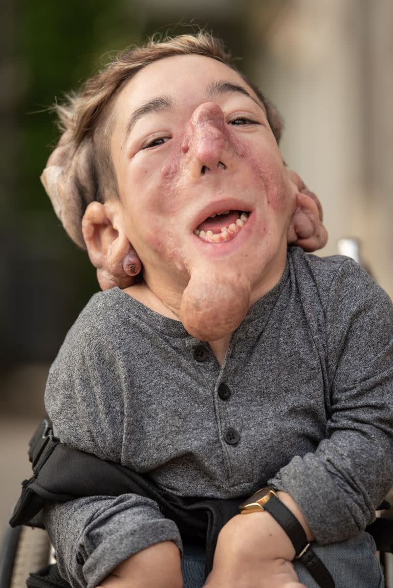 Matías Fernández Burzaco tiene fibromatosis hialina juvenil; hay 60 casos en el mundo y dos en la Argentina