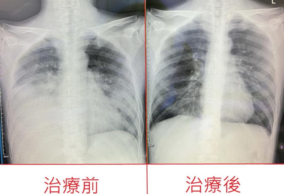 楊老闆８年來每日可以喝下２００ｍｌ至６００ｍｌ的５８度高粱酒或威士忌，就醫檢查發現胸部兩側白肺（左），緊急入住加護病房，所幸醫護團隊２４小時接力奮戰，患者肺炎終於好轉（右）。（記者陳金龍翻攝）