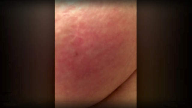 Should I Worry About a Rash on My Breast?