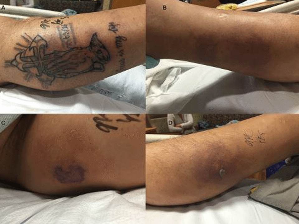 The patient's tattoo and skin lesions (BMJ Case Reports)