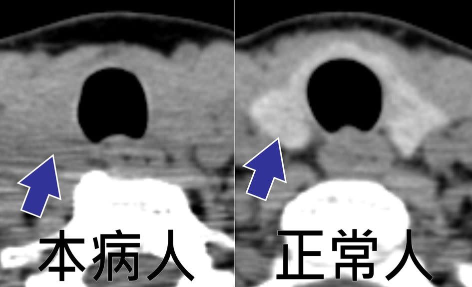 箭頭所指為電腦斷層檢查下之甲狀腺。左圖為該患者，影像密度偏低。右圖為正常人，影像密度較高。(記者黃福鎮翻攝)