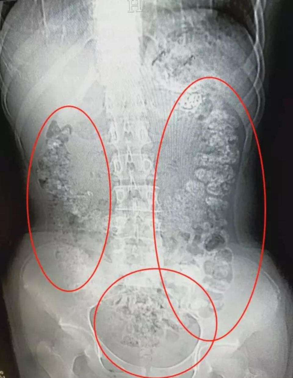 Pic shows: A X-ray showing Zhu Li's stomach filled with undigested tapioca balls.  CHINA: These images show the clogged-up digestive system of a teenage girl who could not do a poo for five days because her stomach and intestines were full of starchy balls from her favourite tea drink.