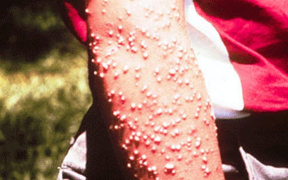 Pustules resulting from fire ant stings