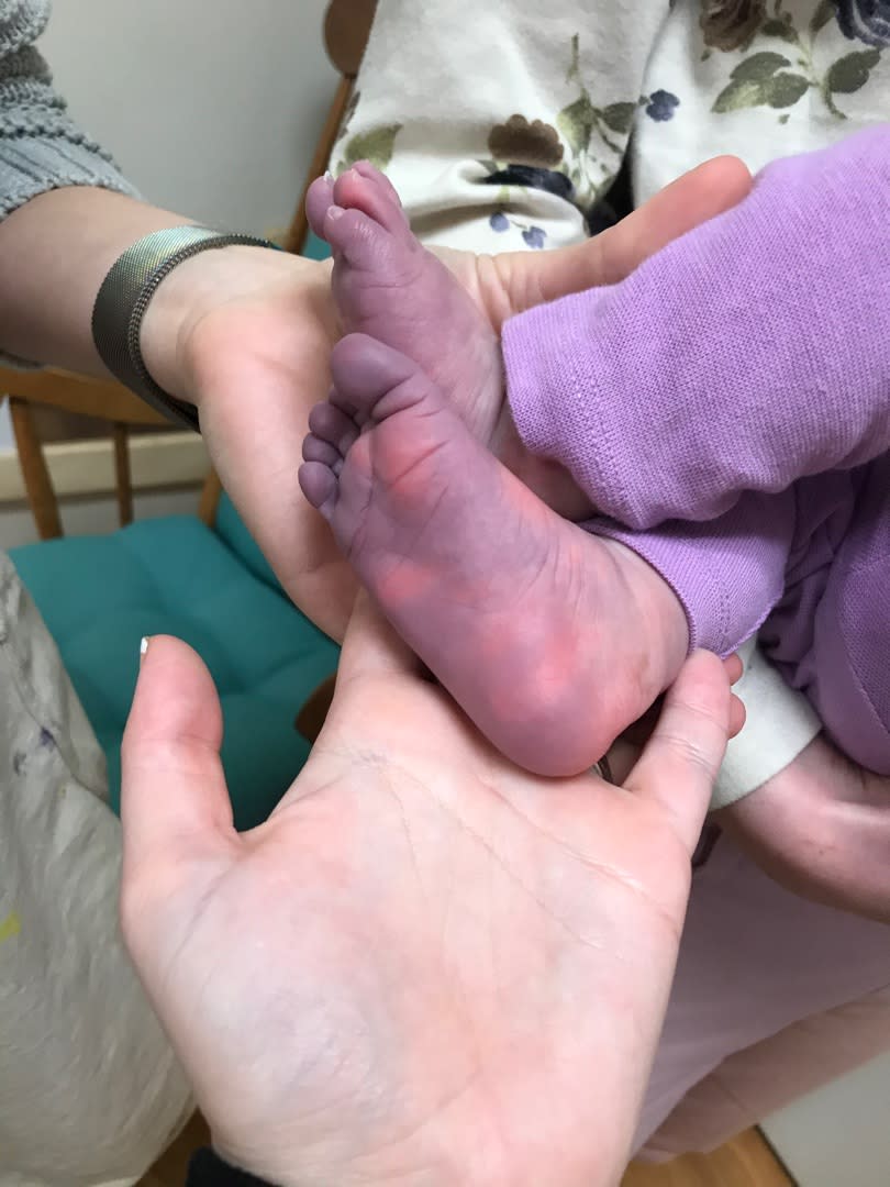 Madelyn's hands and feet turned purple while battling the syndrome. (Supplied: Cleveland Clinic)