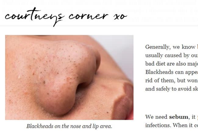 皮膚科醫師提醒，壓迫清除鼻頭粉刺，有可能傷害皮膚組織，反而增加黑色素沉澱，增感染風險（圖／翻攝自《courtneys-corner》）