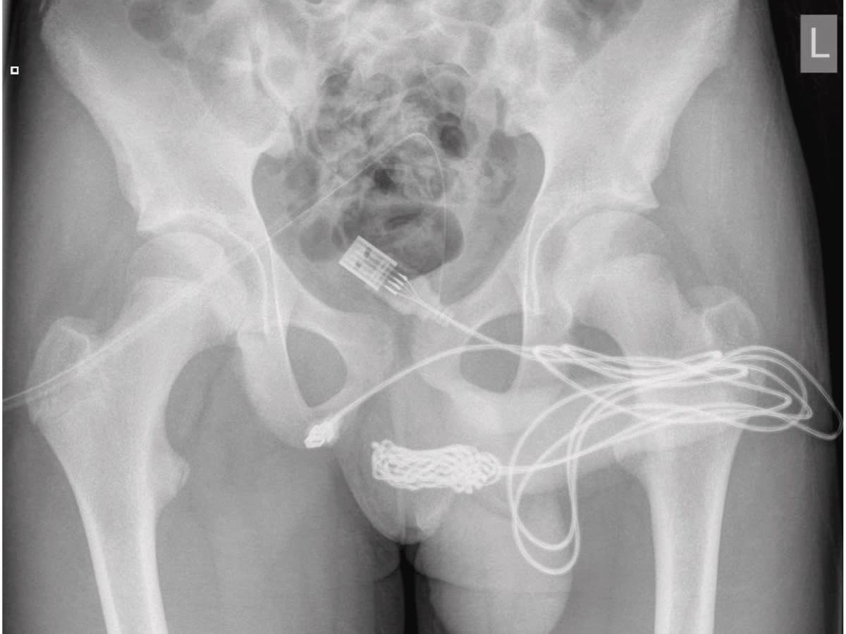 The USB cable knotted inside the teenager's urethra. (Urology Case Reports) 