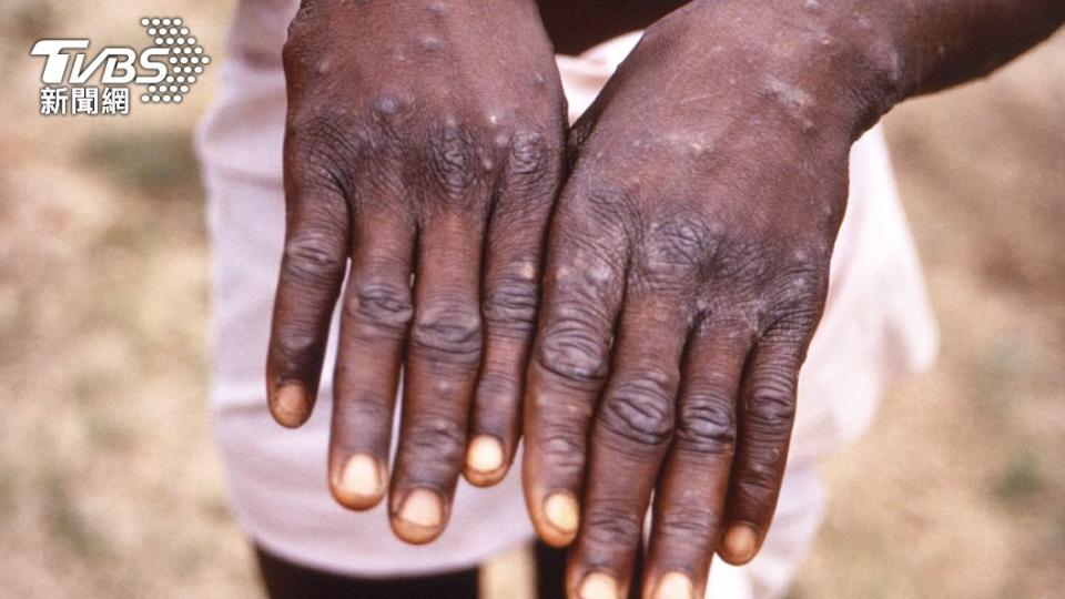 猴痘（monkeypox）已擴散全球13國、累積92起病例。（圖／達志影像美聯社）