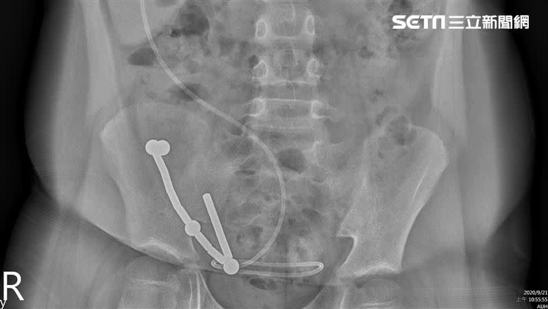 8歲童誤吞磁鐵X光影像（圖／亞大醫院提供）