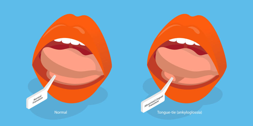 With tongue-tie, the frenulum makes it difficult for the baby's tongue to move or function normally. (Getty Images)