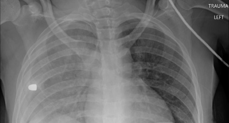 X-Ray image of a child's chest with a bullet inside from a firearm incident. 