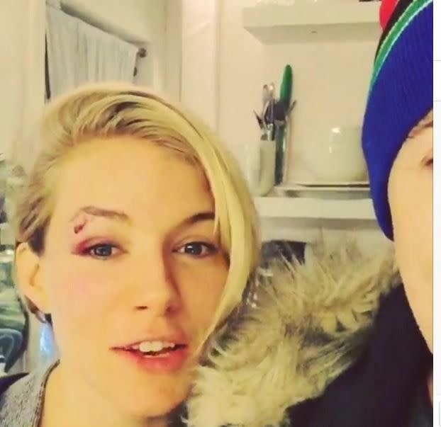 Uh oh, what happened to Sienna Miller? In an Instagram video with her "Cabaret" co-star Alan Cummings, Sienna revealed that she walked into a prop during the show, giving her a nasty black eye and a gash on her face! "Me and Rocky balboa have a special announcement!!" Cummings captioned the video, where he and Miller laughed off the onstage accident.
