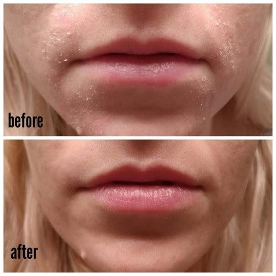 A reviewer's chin before/after use with reduced dryness and flakiness