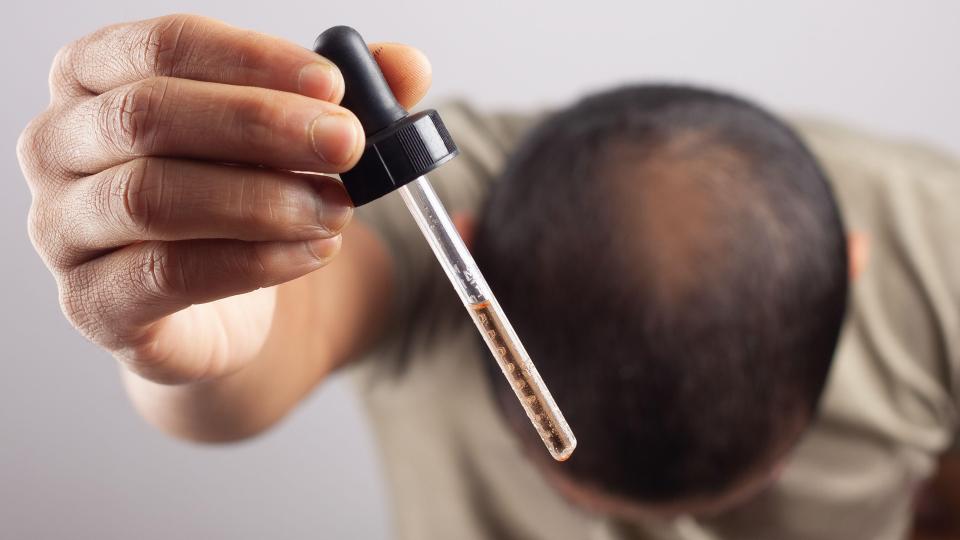 Man holding a dropper going to apply serum to balding scalp.