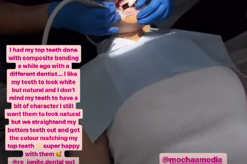 Helen Flanagan shared updates from her composite bonding treatment