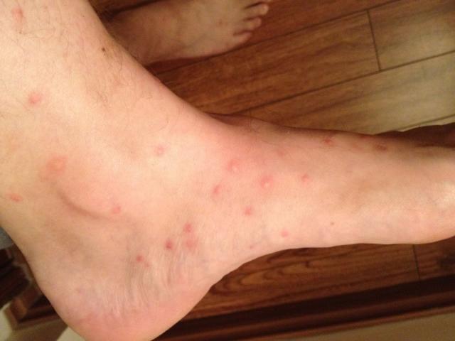 19 Common Bug Bite Pictures - How to ID Insect Bites and Stings