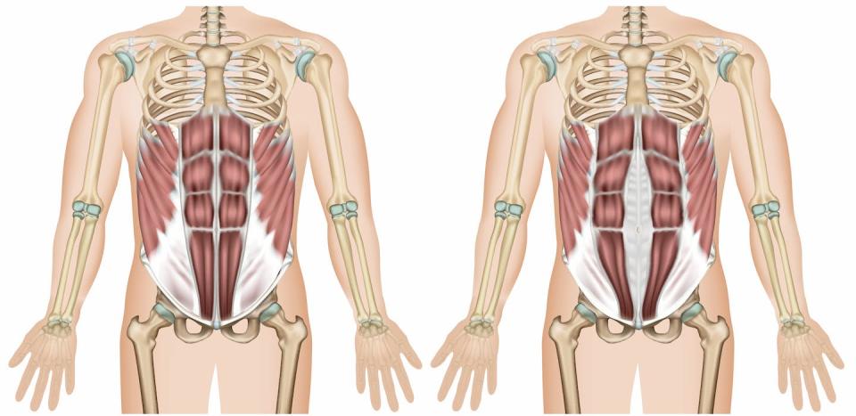 Abdomen normal (izquierda) y abdomen con diástasis (derecha). <a href="https://www.shutterstock.com/es/image-vector/diastasis-recti-3d-medical-vector-illustration-1334343155" rel="nofollow noopener" target="_blank" data-ylk="slk:medicalstocks/Shutterstock;elm:context_link;itc:0;sec:content-canvas" class="link ">medicalstocks/Shutterstock</a>