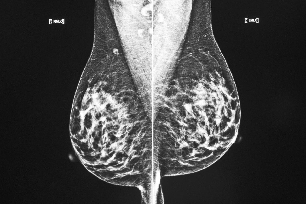 #More breast cancer patients can choose smaller surgery