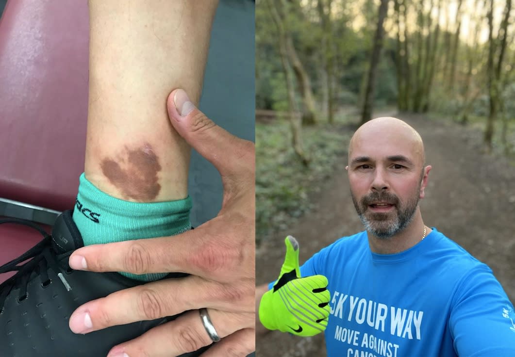 The 'bruise' on John Haywood's ankle turned out to be cancer.  (John Haywood / SWNS)
