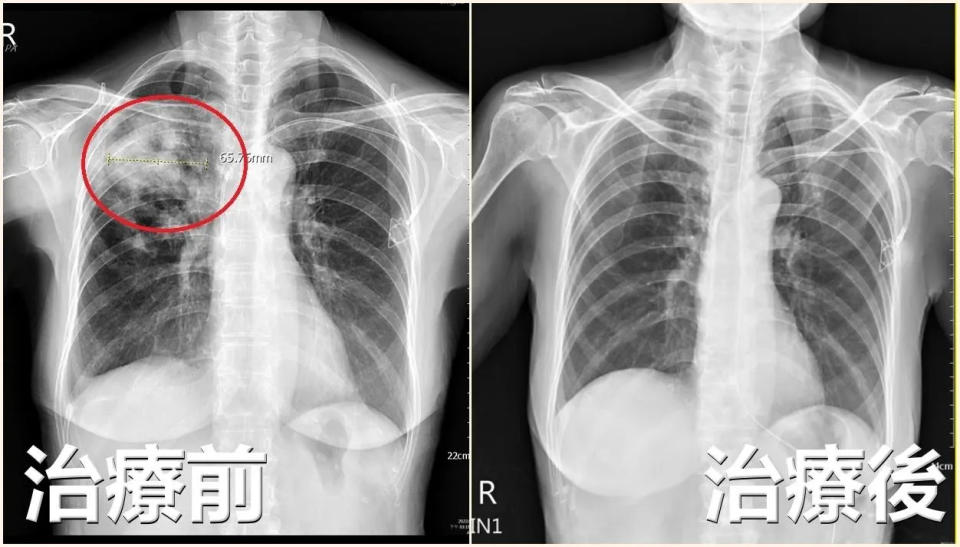 <strong>患者X光檢查影像顯示右上肺葉發炎，宛如「開了一個洞」。（圖／亞大醫院提供）</strong>