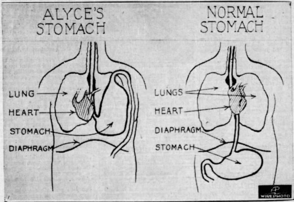 An illustration showing the "upside-down stomach" plaguing Alyce Jane McHenry of Omaha, Nebraska, appeared in the Omaha World-Herald on March 4, 1935. McHenry traveled to Fall River for surgery to correct an "upside-down stomach" and became a national sensation.