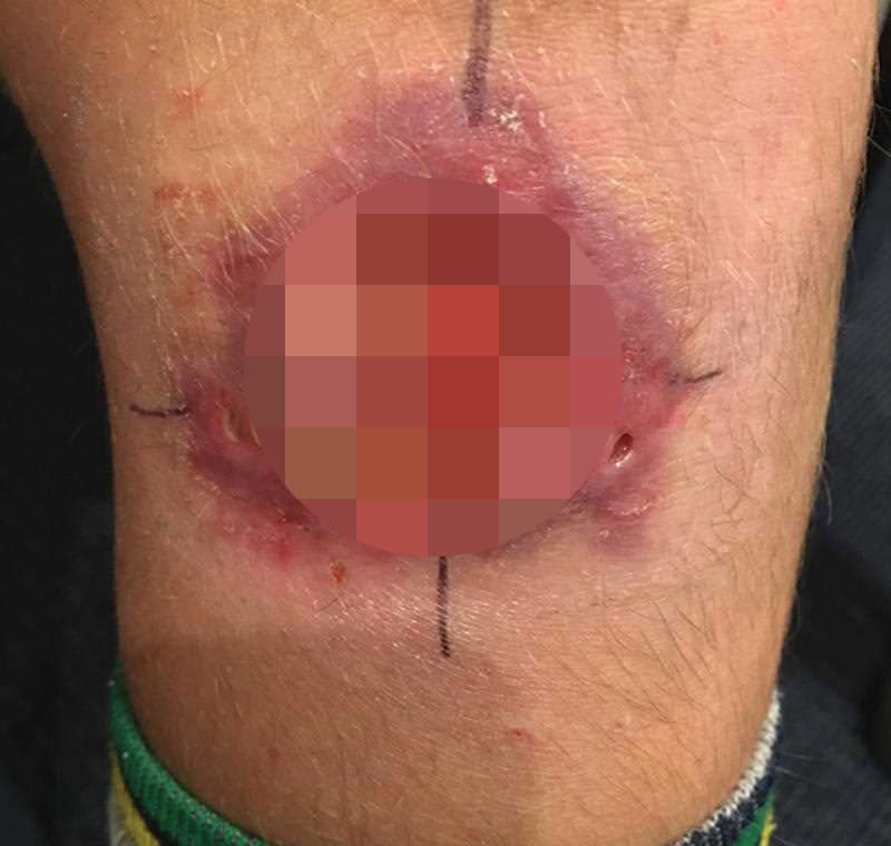 A severe Mycobacterium ulcerans lesion on the knee of an 11-year-old boy is pictured after he got a Buruli ulcer.