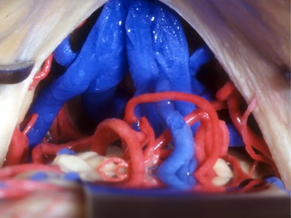 The big blue structure here (dyed by Rhoton for easy viewing) shows where the great cerebral vein drains blood from the cerebrum.