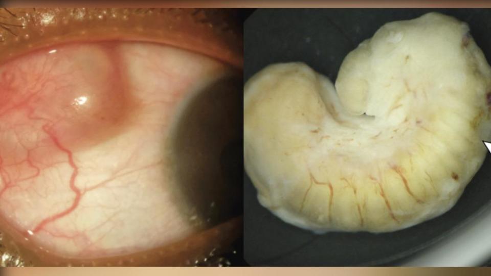 女眼睛裡無痛腫塊竟是名為「五口蟲」的寄生蟲（Pentastomid）。（圖／翻攝自《都市日報》）