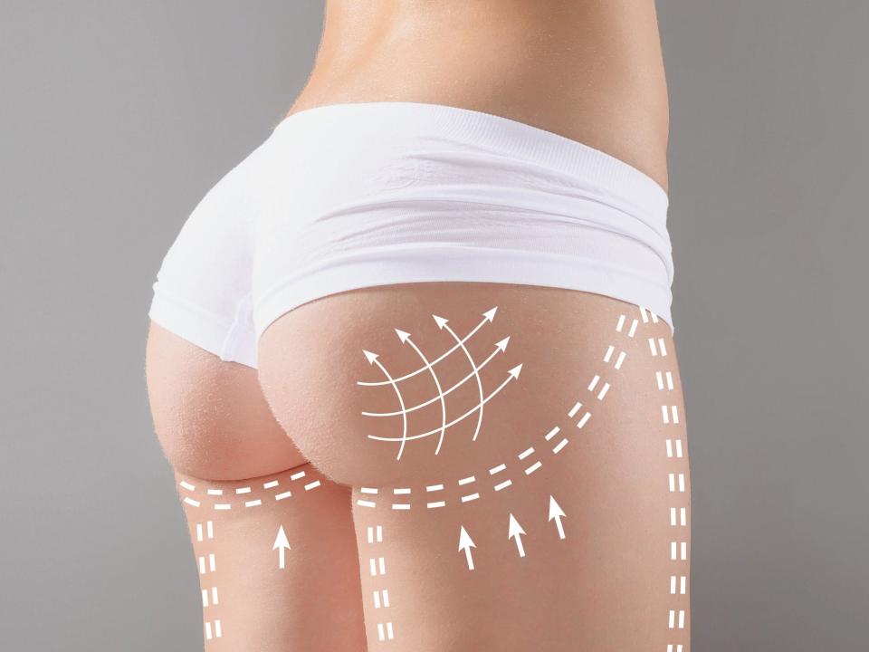 The procedure draws fat from the back or stomach and injects it to reshape the buttocks: Getty Images