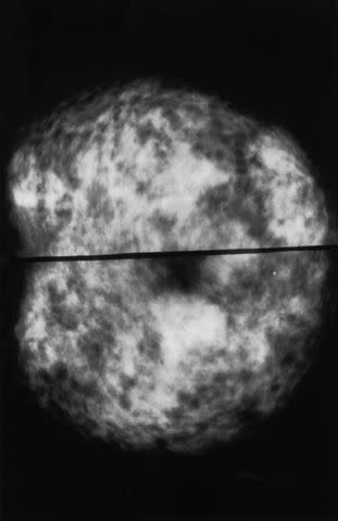 National Cancer Institute Normal Dense Breast Tissue on a Mammogram