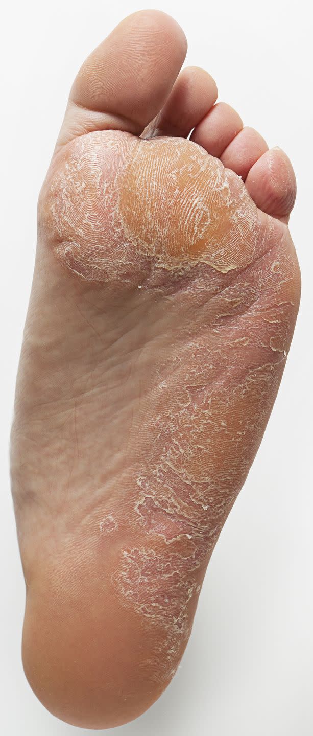 horribly dry foot with callus